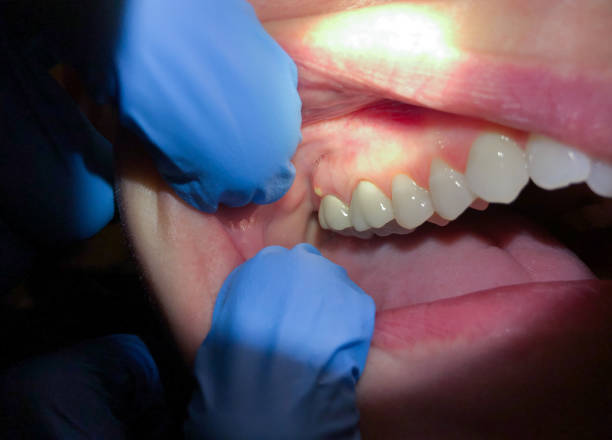 Best Knocked-Out Tooth (Avulsed Tooth) Treatment in Pearl River, MS